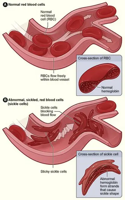 0 world sickle cell day international 06 19